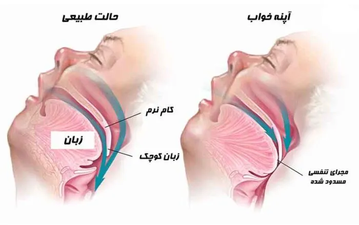 تشخیص آپنه خواب